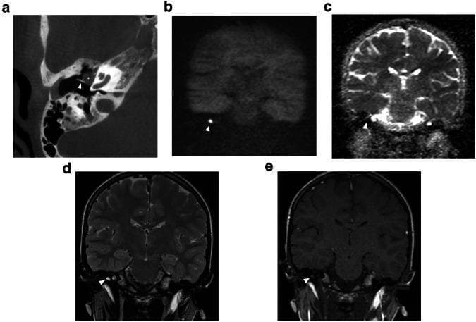 This multi-modal diagnostic image panel demonstrates a congenital middle ear cholesteatoma (CMEC) in an 11-year-old patient. Image (a) is an axial Cone Beam CT (CBCT) showing a well-defined, rounded soft tissue mass (asterisk) in the anterior-superior quadrant of the middle ear, extending medially to the malleus handle (arrowhead). Images (b-e) provide Magnetic Resonance Imaging (MRI) correlations of the same lesion (arrowheads). The lesion exhibits pathognomonic signal characteristics: high signal intensity on non-echo planar diffusion-weighted imaging (DWI b1000, image b) and low signal on the corresponding Apparent Diffusion Coefficient (ADC) map (image c), confirming true restricted diffusion. Coronal T2-weighted (d) and T1-weighted (e) images show intermediate and low signal intensities, respectively. This combination of CT morphology and MRI diffusion restriction is essential for differentiating cholesteatoma from other middle ear pathologies like cholesterol granuloma or inflammatory tissue. The case illustrates the standard radiological protocol for evaluating conductive hearing loss and localizing intratympanic masses in pediatric patients.