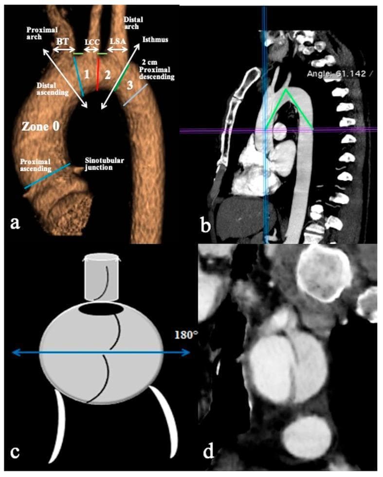 This composite figure illustrates normal and pathological aortic arch anatomy using Computed Tomography Angiography (CTA). Panel (a) is a 3D volume-rendered reconstruction in a parasagittal view identifying key landmarks: the sinotubular junction, proximal and distal ascending aorta (Zone 0), and supra-aortic branches including the brachiocephalic trunk (BT), left common carotid (LCC), and left subclavian artery (LSA). It delineates surgical zones (1, 2, 3) and distances between branch origins. Panel (b) is a parasagittal CTA reconstruction demonstrating the measurement of the aortic arch angle (61.142°), calculated between the arch's highest point and mid-luminal points of the ascending and descending aorta at the level of the pulmonary trunk bifurcation. Panel (c) provides a schematic cross-sectional diagram showing a primary entry tear at the 180° position (convexity) of the aortic arch, compared with tears at the concavity. Panel (d) shows a corresponding coronal CTA reconstruction depicting an aortic dissection flap with the primary entry tear located at the upper circumference of the arch. This educational material is designed for cardiovascular radiology and vascular surgery training regarding aortic dissection classification and morphometric analysis.