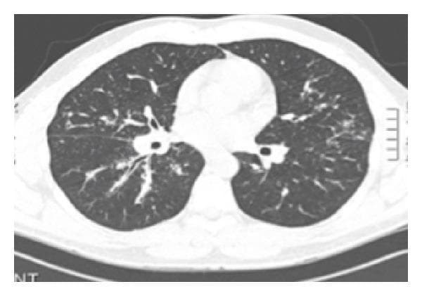 This diagnostic image is an axial chest CT scan using a lung window, demonstrating findings characteristic of Stage 2 sarcoidosis. The primary pathological features include bilateral hilar adenopathy, visualized as symmetric soft tissue masses at the lung roots that obscure normal vascular and bronchial margins. Additionally, there is evidence of diffuse parenchymatous infiltration throughout both lung fields. These infiltrates present as ill-defined nodular opacities with a perilymphatic distribution pattern, typical of granulomatous inflammation. The image serves as a clinical example of pulmonary sarcoidosis involvement, illustrating both lymphatic enlargement and parenchymal disease. It is suitable for medical education regarding thoracic imaging and interstitial lung diseases.