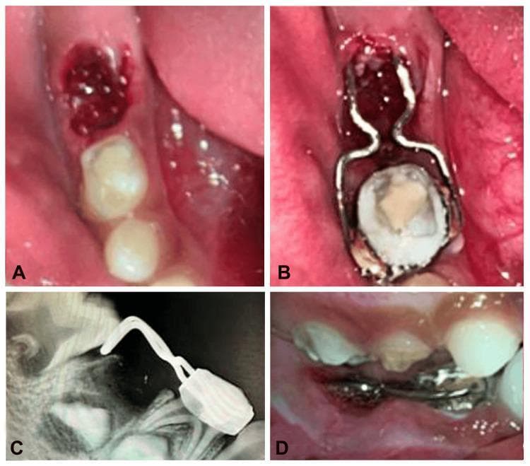 This composite figure illustrates the clinical and radiographic sequence for the placement of a distal shoe space maintainer in a pediatric patient. Panel A shows an intraoral occlusal view of a fresh mandibular extraction socket (tooth 85) containing a blood clot. Panel B displays the distal shoe appliance in situ post-cementation; it consists of a stainless steel band adapted to the primary first molar (tooth 84) with distal wire extensions featuring horizontal adjustment loops. Panel C is a periapical radiograph confirming the correct placement of the appliance's intra-alveolar vertical projection, which serves to guide the eruption of the unerupted permanent first molar (tooth 46) and prevent mesial drifting. Panel D shows a lateral intraoral view of the appliance in occlusion. This sequence demonstrates pediatric interceptive orthodontics and space management after the premature loss of a primary second molar.