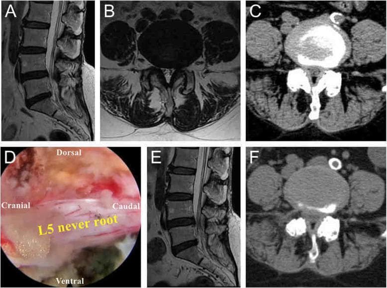 This composite figure demonstrates the preoperative, intraoperative, and postoperative findings of a 60-year-old patient with lateral recess stenosis and L4/5 disc herniation treated with visualized reamed foraminoplasty (VRF). Panels A and B (MRI) and Panel C (CT) represent preoperative imaging, showing significant narrowing of the right lateral recess and compression of the L5 nerve root at the L4/5 level. Panel D is an intraoperative endoscopic photograph showing the L5 nerve root fully released and decompressed. The nerve appears as a white, elongated structure against reddish surgical tissue; directional labels (Dorsal, Ventral, Cranial, Caudal) orient the viewer to the surgical field. Panels E (MRI) and F (CT) provide postoperative imaging, illustrating a successfully enlarged lateral recess and the resolution of compression in both the dorsal and ventral regions of the L5 nerve root. This case highlights the efficacy of the VRF technique in achieving spinal canal decompression and symptomatic relief for radiating leg pain associated with lumbar stenosis.