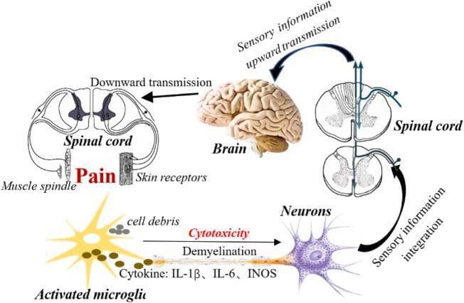 This pathophysiology diagram illustrates the neural pathways and neuroinflammatory mechanisms involved in neuropathic pain (NPP). The schematic follows a feedback loop starting from peripheral receptors, including skin receptors and muscle spindles, which transmit nociceptive signals. These signals undergo 'sensory information integration' within cross-sections of the spinal cord and 'upward transmission' to the brain. The brain subsequently processes this data and sends instructions via 'downward transmission' back through the spinal cord, culminating in the perception of pain. A significant portion of the diagram focuses on the cellular level, depicting an 'Activated microglia' with a star-shaped morphology near 'cell debris.' This microglial cell is shown releasing pro-inflammatory cytokines and factors, specifically IL-1β, IL-6, and iNOS. These substances act upon an adjacent neuron, leading to 'demyelination' and 'cytotoxicity,' which enhances sensory transmission and contributes to the persistence of chronic pain states. This educational visual integrates neuroanatomy, sensory physiology, and neuroimmunology to explain the development of pain following nerve injury.