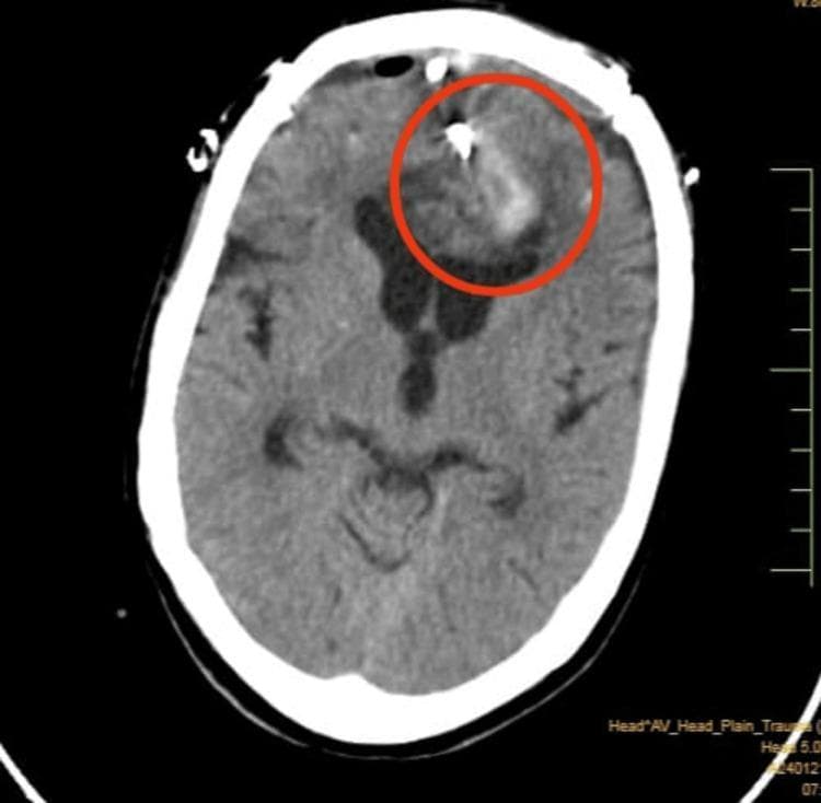 This axial non-contrast CT scan of the brain demonstrates a post-operative state following neurosurgical intervention in the bilateral frontal region. Key features include a bilateral frontal calvarial defect (craniotomy site) with overlying extracranial soft tissue swelling and a visible surgical drain tube. Intracranial findings are highlighted by a red circle, revealing a large, mixed-density intraparenchymal hematoma located in the interhemispheric and parafalcine regions, predominantly affecting the left frontal lobe. A hyperdense metallic focus, consistent with an aneurysm clip, is visible within the anterior interhemispheric region, associated with mild streak artifacts. There is evidence of mass effect, indicated by the effacement of the frontal horn of the left lateral ventricle. Small air-density foci (pneumocephalus) are scattered within the frontal region and adjacent to a thin, mixed-density subdural collection. The imaging illustrates typical post-surgical complications and the management of a ruptured intracranial aneurysm.
