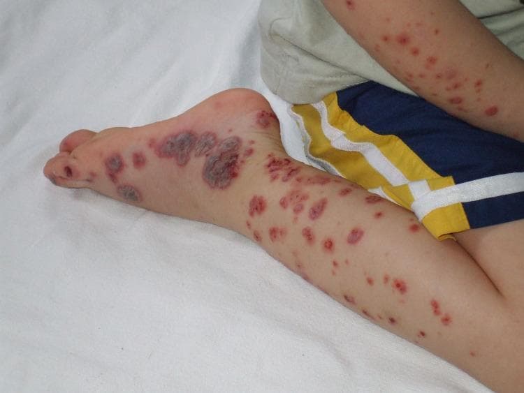 This clinical photograph displays characteristic dermatological manifestations of Henoch-Schönlein purpura (HSP), also known as IgA vasculitis, on the right lower extremity and forearm of a pediatric patient. The image shows a classic distribution of palpable purpura, presenting as numerous erythematous to violaceous macules, papules, and larger confluent plaques. On the lateral aspect and dorsal surface of the foot, the lesions are more severe, appearing as dark, purplish-brown nodular plaques with evidence of central crusting or possible necrosis. The pretibial region and lower leg exhibit a denser concentration of discrete, smaller purpuric spots compared to the proximal thigh. Morphologically, the lesions range from petechiae to larger ecchymotic patches, which are non-blanching and typically found in gravity-dependent areas such as the lower limbs. This visual is an essential educational reference for distinguishing vasculitic rashes from accidental bruising or non-accidental trauma in pediatric medicine, emphasizing the symmetrical and dependent distribution typical of HSP.
