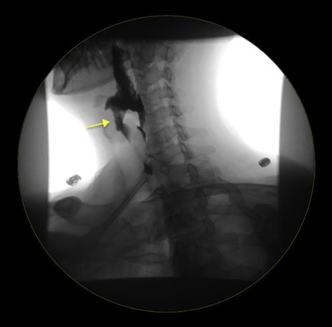 This diagnostic image is a lateral-view contrast esophagram (barium swallow) focusing on the cervical and upper thoracic regions. The radiographic study clearly demonstrates a Zenker's diverticulum, appearing as a contrast-filled outpouching projecting posteriorly from the pharyngoesophageal junction, specifically through Killian's dehiscence above the cricopharyngeal muscle. A yellow arrow points to this prominent sac-like structure, which is located dorsal to the esophageal lumen and anterior to the cervical vertebral column. The contrast agent outlines the normal esophageal lumen distal to the diverticulum, although the diverticulum itself retains a significant volume of the material. Anatomical landmarks visualized include the cervical vertebrae, the mandible, and the soft tissues of the neck. This finding is a classic representation of a pulsion diverticulum, clinically significant for causing dysphagia, regurgitation, and halitosis. It is an essential teaching image for gastroenterology and radiology regarding upper gastrointestinal motility disorders and anatomical defects.