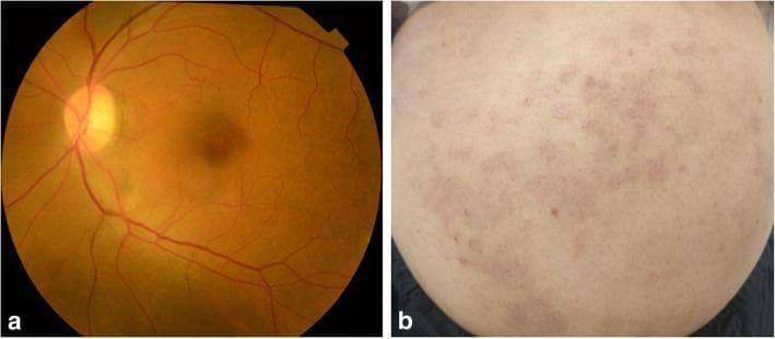 This composite clinical figure demonstrates the multisystemic resolution of a fungal infection (Tinea corporis) after two weeks of antifungal treatment. Image A is a fundus photograph of the left eye showing the posterior pole and mid-periphery. It reveals a resolving retinochoroiditis lesion, characterized by a diffuse, faint yellowish patch with irregular margins located along the inferotemporal vascular arcade. The optic disc, macula, and remaining vasculature appear stable. Image B is a clinical photograph of the abdomen showing multiple resolving skin lesions. These present as scattered, pinkish-red erythematous patches and plaques with less distinct borders compared to the acute phase, set against otherwise normal-appearing skin. The figure highlights the clinical correlation between ophthalmologic findings and dermatologic manifestations in systemic or co-occurring fungal disease, illustrating the typical visual progression of healing during therapeutic intervention.