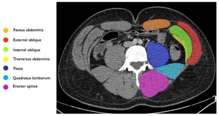 This diagnostic image is an axial CT scan of the abdomen, specifically annotated to demonstrate the anatomy of the abdominal wall musculature. The cross-section provides a clear view of the bilateral symmetry and layered arrangement of the core muscles. Anteriorly, the rectus abdominis is highlighted in orange. Moving laterally, the three distinct layers of the lateral abdominal wall are identified: the external oblique (red) as the most superficial layer, the internal oblique (green) in the middle, and the transversus abdominis (yellow) as the deep layer. In the posterior compartment, the psoas muscle (dark blue) is shown adjacent to the vertebral body. Posterior and lateral to the psoas is the quadratus lumborum (light blue), while the erector spinae group (magenta) is situated most posteriorly along the spine. This anatomical diagram serves as a key reference for identifying muscle boundaries in clinical imaging, essential for diagnosing abdominal wall hernias, hematomas, or planning surgical and interventional procedures like embolization for active bleeding.