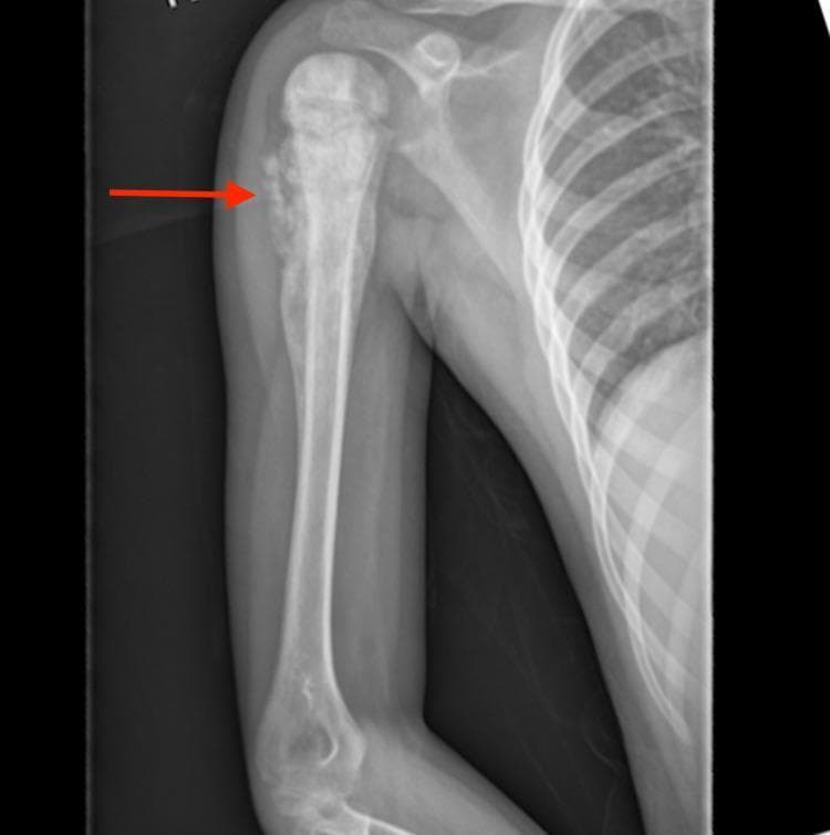 Anterior-Posterior (AP) radiograph of the right humerus demonstrating an aggressive, primary bone tumor, consistent with osteosarcoma. The lesion is primarily centered in the proximal metaphyseal region with significant extension into the diaphysis. Key diagnostic features include an aggressive periosteal reaction characterized by a Codman triangle (indicated by a red arrow), where the periosteum is being lifted away from the bone by the rapidly growing tumor. Additionally, there is evidence of osteoid production resulting in a 'cloud-like' or fluffy ivory-white appearance of tumor bone formation within the soft tissue. The zone of transition between the malignant process and normal bone is wide and ill-defined, signifying high biological activity and infiltrative growth. The image serves as a classic educational example of malignant orthopedic oncology findings in a pediatric patient.