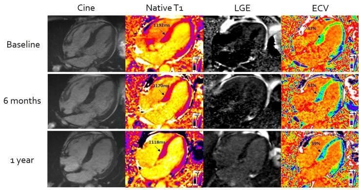 This diagnostic image panel displays serial cardiovascular magnetic resonance (CMR) imaging in a patient with cardiac systemic light-chain (AL) amyloidosis, illustrating tissue characterization changes over a 1-year treatment period. The grid displays four imaging modalities—Cine, Native T1 mapping, Late Gadolinium Enhancement (LGE), and Extracellular Volume (ECV) mapping—across three rows representing Baseline, 6 months, and 1 year post-chemotherapy. The Native T1 mapping shows a progressive decrease in T1 values from 1192ms to 1118ms, visualized by a color shift from warm orange to cooler yellow tones. The LGE column demonstrates a significant reduction in myocardial contrast hyperintensity, indicating regression of amyloid deposition. Correspondingly, the ECV maps show a quantitative decline from 47% at baseline to 39% at one year, reflecting the reduction in the expanded extracellular space. This longitudinal comparison serves as an educational tool for monitoring treatment response in infiltrative cardiomyopathies through advanced parametric mapping and contrast-enhanced imaging techniques.
