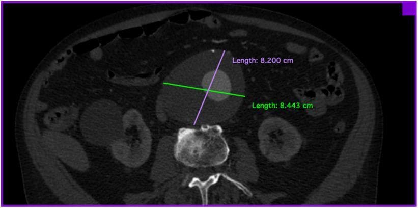 This diagnostic image is a preoperative axial computed tomography (CT) scan of the abdomen demonstrating a large infrarenal abdominal aortic aneurysm (AAA). The aneurysm is visualized as a significantly dilated vascular structure located anterior to the lumbar vertebral body. Digital calipers measure the transverse diameter of the aneurysm at approximately 8.2 cm by 8.44 cm. The scan reveals a contrast-enhanced patent lumen surrounded by a substantial layer of non-enhancing mural thrombus, which contributes to the overall vessel expansion. The surrounding abdominal anatomy shows the aneurysm's mass effect on adjacent soft tissues, with the kidneys visible bilaterally in their retroperitoneal positions. This image illustrates a high-risk vascular condition requiring surgical intervention, such as endovascular aneurysm repair (EVAR), and serves as a classic representation of advanced aortic pathology for medical training in vascular surgery and radiology.