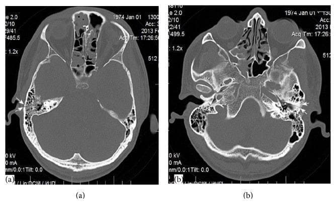This diagnostic image consists of two axial non-contrast Computed Tomography (CT) scans of the skull base, specifically focusing on the temporal bones. Image (a) displays the right petrous temporal bone, and image (b) displays the left. In both images, white arrows highlight dark, linear radiolucent lines indicating nondisplaced transverse temporal bone fractures. These fractures originate at the posterior aspect of the petrous pyramid and extend across the long axis toward the internal auditory canal. Key anatomical landmarks visible include the mastoid air cells, sphenoid sinus, ethmoid cells, and the bony margins of the posterior and middle cranial fossae. These findings are clinically significant for patients presenting with post-traumatic facial nerve paralysis and sensorineural hearing loss, as transverse fractures are more likely than longitudinal fractures to involve the otic capsule or the internal auditory canal where the VII and VIII cranial nerves reside. This content is intended for medical training in radiology and otolaryngology to differentiate between temporal bone fracture orientations following blunt head trauma.