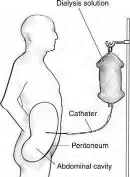 This medical anatomical diagram illustrates the standard setup for Continuous Ambulatory Peritoneal Dialysis (CAPD). The illustration features a lateral profile of a human figure positioned next to a dialysis solution bag suspended on an IV pole. A catheter is shown extending from the solution bag, penetrating the anterior abdominal wall, and passing through the parietal peritoneum. Within the abdominal cavity, the catheter is depicted with its distal tip correctly positioned in the pelvic region. Key anatomical structures and components are labeled, including the 'Dialysis solution,' 'Catheter,' 'Peritoneum,' and 'Abdominal cavity.' This educational visual serves to demonstrate the trans-abdominal pathway and the specific intra-abdominal placement required for effective peritoneal exchange of electrolytes and waste products. The diagram highlights the clinical importance of distal tip placement in the pelvis, which holds the greatest volume of dialysate, to ensure optimal treatment efficacy.