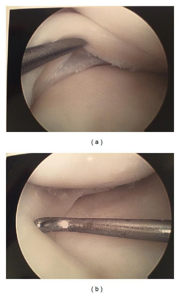This diagnostic clinical image presents a side-by-side arthroscopic comparison of a left knee joint during a medial meniscus repair. Modality: Arthroscopy (Endoscopy). Anatomical Region: Knee joint, specifically the medial compartment. Panel (a) shows the prefixation state, demonstrating a bucket-handle type tear in the red-white zone of the medial meniscus. A metallic surgical probe is being used to manipulate the tear, revealing clean, non-frayed edges and smooth surrounding meniscal tissue. Panel (b) illustrates the postfixation state where the tear has been stabilized using an all-inside knotless suture-anchor technique. The metallic probe is again visible, confirming the integrity and reduction of the meniscal fragment against the periphery. The surrounding articular cartilage appears healthy and white. Educational significance: This image illustrates the intraoperative assessment of meniscal pathology and the visual outcome of a successful surgical repair, emphasizing the importance of probe examination to determine tissue viability and fixation stability in orthopedic sports medicine.