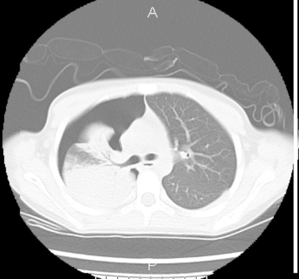 This diagnostic image is an axial computed tomography (CT) scan of the thorax, presented in a lung window. The image demonstrates a significant right-sided pneumothorax, characterized by an extensive collection of air in the pleural space, resulting in a substantial partial collapse of the right lung. Within the collapsed right lung, there is evidence of pulmonary consolidation and ground-glass opacities, particularly in the dependent regions, which is suggestive of lobar pneumonia or associated inflammation. In contrast, the left lung (labeled on the right side of the image) appears well-aerated with normal vascular markings and a clear bronchogram, without signs of consolidation or pleural effusion. The mediastinum shows a slight shift toward the left, secondary to the pressure exerted by the large right-sided pneumothorax. This scan is illustrative for medical students and clinicians studying emergency respiratory conditions, thoracic trauma, or complications of pulmonary infections like pneumonia.