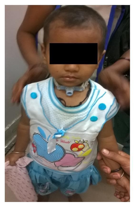 Clinical photograph of a 10-month-old female patient showing a long-term tracheostomy in situ. The infant is depicted in a front-facing view, with a standard pediatric tracheostomy tube secured around the neck using a soft white tie or strap. The tube's flange is visible against the skin, and a blue three-way valve or heat and moisture exchanger (HME) is attached to the tracheal opening. The image illustrates post-acute management of airway obstruction, following complications from lithium battery ingestion and subsequent bilateral vocal cord palsy. The anatomical focus is the anterior neck region where the surgical airway is maintained. The photograph serves to demonstrate clinical follow-up and the use of medical devices for chronic airway management in pediatric patients with vocal cord dysfunction.