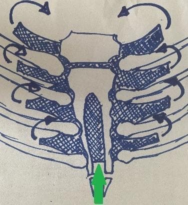 This medical illustration depicts an anatomical diagram of the anterior thoracic wall, specifically focusing on a surgical intervention for a lower bifid sternum (sternal cleft). The diagram shows the manubrium, the bilateral sternal bars, and the articulating ribs. A central gap is visible between the inferior portions of the sternal bars, representing the congenital defect. A green arrow points to a cross-hatched, oblong prosthesis positioned behind the sternum in the retrosternal plane. Black curved arrows indicate the vectors of mechanical approximation, illustrating how the prosthesis facilitates the medial transposition of the sternal bars to close the midline diastasis. The illustration serves as a pedagogical tool for pediatric thoracic surgery, demonstrating the use of a mesh or prosthetic graft to restore the structural integrity and biomechanical stability of the chest wall in cases of sternal malformation.