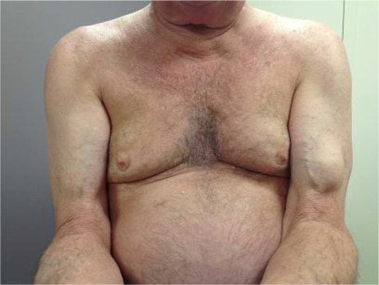This clinical photograph shows the upper torso and bilateral arms of an elderly male patient. The primary finding is a prominent, well-defined, rounded mass located on the anterior aspect of the left mid-upper arm, creating a significant contour deformity compared to the contralateral side. This visual manifestation is known as the 'Popeye sign' (or Popeye deformity), which indicates a rupture of the long head of the biceps brachii tendon. The rupture causes the muscle belly to retract distally toward the elbow, forming the characteristic bulge. The patient displays age-related skin changes, including fine wrinkling, thinning of the dermis, and prominent superficial veins in the forearms. No acute ecchymosis or inflammatory skin changes are visible, suggesting a chronic or non-acute presentation. This image is used in medical education to demonstrate classic physical examination findings in musculoskeletal pathology and orthopedic trauma.