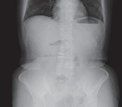 This abdominal plain radiograph (supine X-ray) demonstrates marked gaseous distension of multiple small bowel loops, primarily located in the central abdomen. The loops are dilated significantly beyond the normal 3cm threshold, suggesting a small bowel obstruction or paralytic ileus. A notable clinical feature is the 'gasless' appearance or lack of significant dilatation in the large bowel (colon), which is characteristic of an obstructive process occurring proximal to the ileocecal valve. Key radiological landmarks include visible valvulae conniventes within the distended loops and a gastric bubble in the left upper quadrant. The absence of gas in the rectum or distal colon supports a diagnosis of mechanical small bowel obstruction. This imaging modality is a primary diagnostic tool for assessing acute abdominal pain and distension, providing evidence of intestinal transition zones and potential complications such as perforation (though no pneumoperitoneum is visible here).