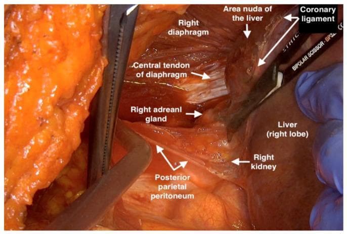 This clinical photograph captures an intraoperative view of the right upper abdominal quadrant during a surgical dissection, specifically showing the mobilization of the liver. The image demonstrates the anatomical relationship between the right diaphragm, liver, and retroperitoneal structures. Key labeled landmarks include the striated right diaphragm and its whitish, fibrous central tendon. The liver's right lobe is retracted, exposing the coronary ligament and the 'area nuda' (bare area) of the liver. In the retroperitoneal space, the yellowish right adrenal gland and the superior aspect of the right kidney are visible. The posterior parietal peritoneum is seen as a thin, translucent membrane being dissected. Surgical instruments, including bipolar scissors and retractors, are positioned to provide exposure of the diaphragmatic area. This visual serves as an educational resource for understanding surgical anatomy and the planes of dissection required for liver mobilization and posterior parietal peritonectomy.