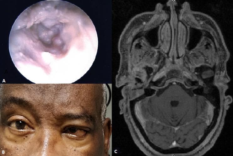 This composite figure illustrates a clinical case of fungal malignant external otitis (necrotizing otitis externa) through three modalities: endoscopic photography, clinical photography, and diagnostic imaging. Image A is an otoscopic view of the external auditory canal showing extensive pale, fleshy granulation tissue with irregular, bumpy morphology and inflammatory exudate obstructing the lumen. Image B is a clinical photograph of a patient's mid-face demonstrating cranial nerve involvement, specifically characterized by facial nerve palsy manifesting as right-sided facial asymmetry and ptosis. Image C is an axial MRI scan (T1-weighted) at the level of the skull base, showing soft tissue infiltration and inflammatory changes in the infratemporal fossa and the vicinity of the stylomastoid foramen, consistent with the spread of infection. Collectively, these images represent the diagnostic triad of malignant external otitis: visible otoscopic pathology, neurological complications such as facial nerve paralysis, and radiological evidence of skull base osteomyelitis or soft tissue extension.