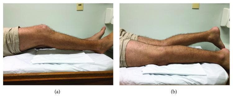 Clinical photograph in two panels (a and b) demonstrating a comparison of knee extension in a 25-year-old male patient. The patient is positioned prone on an examination table with the distal lower legs and feet hanging off the edge. A white cloth is placed under the mid-thighs for comfort and positioning. Panel (a) provides a lateral view of the right lower limb, showing a significant knee extension deficit (approximately 30 degrees of flexion) and hamstring contracture. Panel (b) offers a comparative view of both legs, highlighting the asymmetry between the affected right knee, which remains flexed, and the contralateral left knee, which exhibits full extension. This visual represents a clinical sign of arthrogenic muscle inhibition or mechanical locking following a meniscus injury (bucket handle tear). The image illustrates a key orthopedic physical examination finding used to assess range of motion and joint pathology in sports medicine and emergency orthopedics.