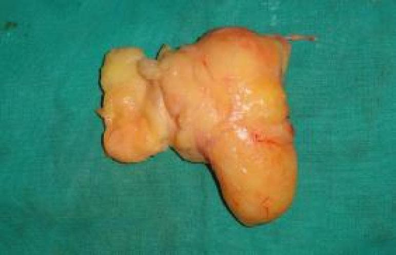 This clinical photograph displays a gross surgical specimen of a resected lipoma placed on a green sterile surgical drape. The specimen exhibits classic features of a benign fatty tumor, characterized by a distinct yellowish-orange color, consistent with mature adipose tissue. The morphology is lobulated and irregular, composed of a larger primary mass and smaller interconnected lobes. The surface texture varies from smooth to mildly irregular, with a thin, glistening translucent capsule visible. Fine red markings across the surface indicate minor superficial vascularity or remnants from the surgical dissection. The image serves as an educational example of soft tissue pathology, specifically illustrating the macroscopic appearance of a large subcutaneous or deep-seated lipoma following surgical excision from a distal forearm.