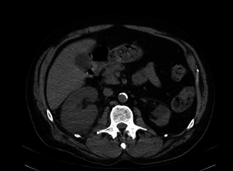 An axial view of a computerized tomography (CT) scan of the abdomen with intravenous contrast, demonstrating diagnostic findings of acute right pyelonephritis. The right kidney is significantly enlarged compared to the left and exhibits a heterogeneous enhancement pattern with prominent hypodense, wedge-shaped areas within the renal parenchyma, suggesting edema or impaired perfusion. The left kidney appears relatively normal in size and enhancement. Other visible structures include the liver in the right upper quadrant, the spleen on the left, and the centrally located lumbar vertebrae. The abdominal aorta is visible anterior to the spine with calcification present in the vessel wall. This diagnostic image is representative of clinical nephrology and radiology, highlighting the classic radiographic appearance of a complicated urinary tract infection leading to renal inflammation.