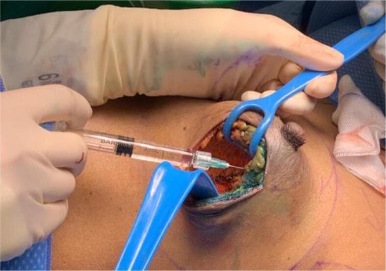 This clinical photograph captures an intra-operative view of a wide local excision (WLE) during breast cancer surgery. The surgical site is held open by two blue plastic Langenbeck-style retractors, exposing the tumor bed cavity. A surgeon, wearing sterile gloves, is shown injecting stabilized hyaluronic acid (sHA) gel into the excision margins using a 3 mL clear syringe with a fine-gauge needle. The cavity walls exhibit heterogeneous tissue characteristics, including reddish-brown areas of cauterized tissue and greenish-yellow highlights representing the injected gel marker. The nipple-areola complex is visible adjacent to the surgical field, providing anatomical orientation. This procedure demonstrates a technique for marking the tumor bed to assist in future radiotherapy planning, specifically designed to improve visibility on post-operative MRI scans compared to traditional metallic clips. The educational focus is on oncoplastic maneuvers and the methodology of tumor bed delineation using radiotranslucent marking materials.