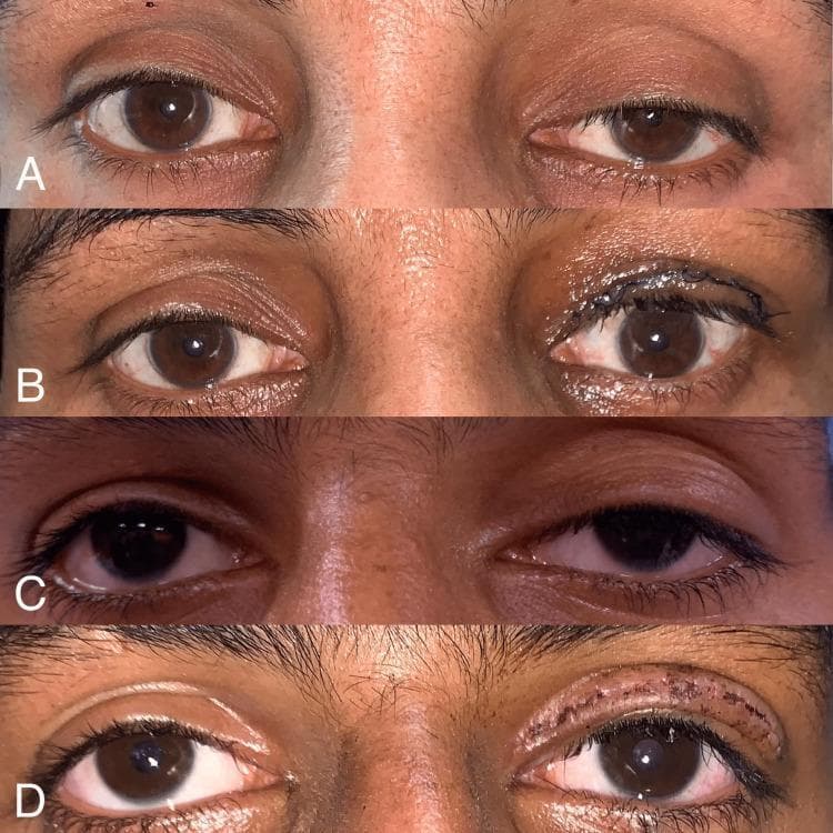 Clinical photographs in four panels (A-D) demonstrating pre-operative and post-operative outcomes of levator resection for congenital ptosis. Panels A and C show the pre-operative status of two different patients. Panel A illustrates mild unilateral ptosis of the left eye, where the upper eyelid margin covers a portion of the superior iris. Panel C demonstrates severe unilateral ptosis of the left eye with the eyelid margin obstructing the visual axis and covering the pupil. Panels B and D show the corresponding post-operative results. In Panel B, the left upper eyelid is elevated to a functional position, increasing the marginal reflex distance 1 (MRD1) and revealing a sliver of superior sclera. Panel D shows the correction of severe ptosis, with the eyelid margin now positioned above the pupil; visible surgical sutures and post-operative erythema are present along the newly defined eyelid crease. The collection serves to illustrate the surgical management of blepharoptosis and the objective assessment of eyelid height and symmetry in ophthalmic plastic surgery.