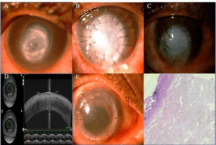 This composite figure illustrates the clinical progression and management of a perforated fungal corneal ulcer through various imaging modalities. (A) Slit-lamp clinical photograph showing a large, central perforated corneal ulcer with a pseudo-cornea, diffuse stromal infiltrates, and an inferiorly shallow anterior chamber. (B) Immediate postoperative appearance following therapeutic penetrating keratoplasty (TPK), displaying a sutured, opaque host tissue graft with circumcorneal injection. (C) One-year follow-up showing a completely opaque graft with inferior conjunctivalization. (D) Anterior segment optical coherence tomography (ASOCT) cross-section demonstrating a thick, epithelialized corneal graft with an apposed graft-host junction. (E) Clinical photograph following a subsequent optical penetrating keratoplasty, showing improved graft clarity and radial sutures. (F) Histopathology (H&E stain, 40x) revealing a stratified squamous non-keratinized five-layer epithelium with underlying edematous stroma. The series highlights the transition from acute infection and perforation to therapeutic stabilization and eventual optical rehabilitation in ophthalmology.
