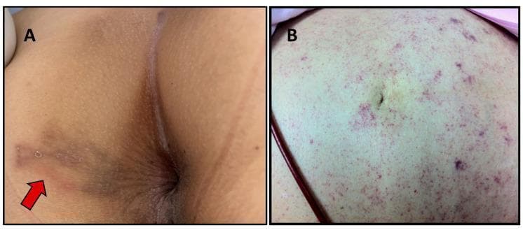 This composite clinical photograph displays two distinct dermatological manifestations of Strongyloides stercoralis infection. Image A shows larva currens in the perianal region, characterized by a serpiginous, erythematous, and slightly raised linear track (indicated by a red arrow). This pathognomonic lesion represents the rapid intradermal migration of filariform larvae. Image B displays a periumbilical 'thumbprint' purpura in a patient with disseminated strongyloidiasis. The abdominal skin exhibits extensive, non-blanching purpuric macules and petechiae, appearing as clusters of reddish-purple spots that are most concentrated in the periumbilical area. These lesions result from larvae migrating through the vessel walls into the dermis. The educational focus is on distinguishing the localized cutaneous signs of chronic infection from the systemic vascular signs associated with severe, disseminated hyperinfection syndrome in immunocompromised hosts.