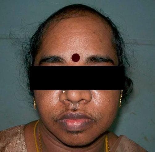 This clinical photograph displays significant dermatological and endocrine-related signs on a female patient, illustrating virilization. The primary finding is androgenic alopecia, characterized by a receding hairline and marked thinning of the hair at the frontal and temporal scalp, following a male-pattern distribution. Additionally, the patient exhibits severe hirsutism, with coarse terminal hair growth visible on the upper lip, chin, and mandibular regions. Notable stubble in these areas suggests recent hair removal efforts. The facial skin appears slightly oily with scattered blemishes on the cheeks, possibly related to hyperandrogenism. These visual features—male-pattern baldness combined with excess facial hair in a female—are classic indicators of hyperandrogenic states, such as those caused by androgen-secreting tumors or severe polycystic ovary syndrome (PCOS).