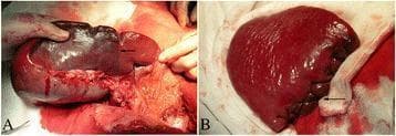 This clinical photograph displays two stages of a subtotal splenectomy during a surgical procedure for portal hypertension. Image A shows the intraoperative identification of the ischemic separatrix (indicated by an arrow) following the ligation of the splenic artery stem and the lienorenal, splenophrenic, and gastrosplenic ligaments. A clear demarcation is visible between the well-perfused red splenic tissue and the darker, congested ischemic portion designated for resection. Image B illustrates the surgical reconstruction of the residual spleen. The cut surface is managed using a horizontal mattress cross-suture technique (indicated by an arrow), which provides effective hemostasis and closure of the splenic parenchyma. The image demonstrates a specialized surgical approach aimed at preserving splenic function (immunological and phagocytic) while addressing complications of portal hypertension and splenomegaly. Key educational concepts include surgical anatomy of splenic ligaments, vascular ligation patterns, and techniques for parenchymal suturing in organ-preserving surgery.