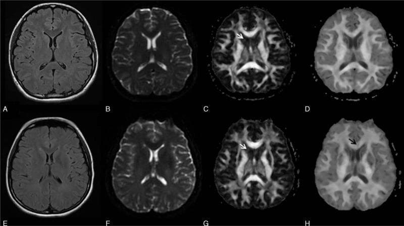 This diagnostic comparison uses axial brain MRI sequences to illustrate neuroimaging findings in acute carbon monoxide (CO) poisoning. The top row (A-D) shows a healthy control subject, while the bottom row (E-H) represents a patient four days after CO exposure. The imaging modalities include Fluid-Attenuated Inversion Recovery (FLAIR; A, E), T2-weighted imaging (B, F), Fractional Anisotropy (FA) maps (C, G), and Mean Kurtosis (MK) maps (D, H). While conventional FLAIR, T2, and FA maps appear unremarkable and show no visible pathology in the acute phase, the MK map (H) reveals a distinct region of hypointensity in the genu of the corpus callosum (indicated by a black arrow), reflecting early microstructural white matter changes. Additionally, white arrows highlight that the MK maps (D, H) provide superior anatomical delineation between the caudate nuclei and lateral ventricles compared to FA maps (C, G), due to reduced sensitivity to cerebrospinal fluid (CSF) contamination. This educational comparison demonstrates the increased sensitivity of Diffusional Kurtosis Imaging (DKI) in detecting acute toxic-ischemic encephalopathy.