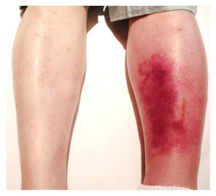 This clinical photograph shows a posterior view of a patient's lower legs, providing a side-by-side comparison between a healthy limb and a symptomatic one. The left lower leg (right side of the image) exhibits classic clinical signs of cellulitis, characterized by significant unilateral edema and diffuse erythema. The affected skin shows a spectrum of inflammatory discoloration, ranging from bright red to deep purplish hues, particularly over the calf region. The skin texture appears tense and glossy due to underlying swelling. A thin, vertical line of serous fluid exudate is visible on the posterior-lateral aspect of the left calf. In contrast, the right lower leg (left side of the image) appears normal with healthy skin tone and no evidence of swelling. This visual demonstrates the acute presentation of a soft tissue infection, useful for teaching the differential diagnosis of unilateral leg swelling and redness, which may include cellulitis, deep vein thrombosis (DVT), or localized vasculitis.