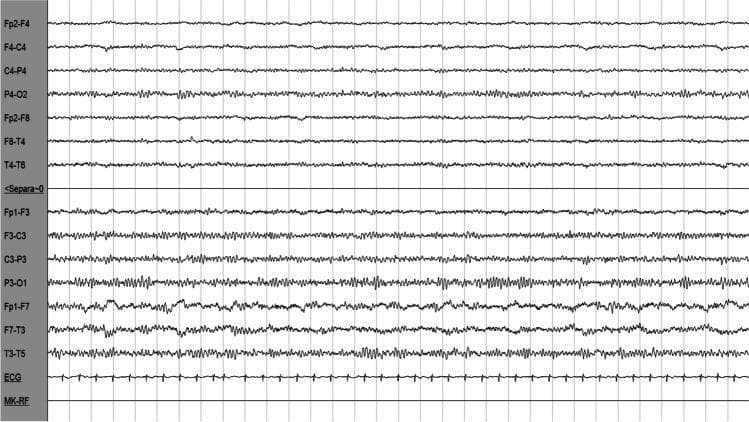 Diagnostic Image: This is an electroencephalography (EEG) tracing showing a longitudinal bipolar montage (P2 montage) alongside a single-lead electrocardiography (ECG) channel. The EEG displays cortical electrical activity from both hemispheres. The upper set of derivations (Fp2-F4 through T4-T6) corresponds to the left hemisphere, while the lower set (Fp1-F3 through T3-T5) corresponds to the right hemisphere. The right-sided derivations demonstrate a clear asymmetry characterized by higher-amplitude, lower-frequency slow-wave activity (delta and theta ranges), particularly prominent in the temporal and posterior leads (F7-T3, T3-T5, P3-O1). There is a notable absence of epileptiform discharges, such as spikes or sharp waves. The recording parameters indicate a paper speed of 1.5 cm/s, a sensitivity of 7.0 uV/mm, and a high-frequency filter setting of 70.0 Hz. This tracing illustrates focal cerebral dysfunction, clinically associated in this context with nonketotic hyperglycemic hyperosmolar state (NKHHS) affecting the right hemisphere.