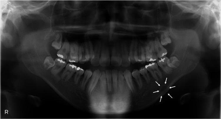 This diagnostic panoramic radiograph (orthopantomogram) displays the complete dentition, maxilla, and mandible. The primary clinical finding is a unilocular radiolucent lesion located in the left posterior mandible, specifically below the inferior alveolar nerve canal (mandibular canal) in the region apical to the first molar. The lesion is indicated by white arrows and exhibits a well-defined, corticated margin with a circular shape and internally homogeneous radiolucency. Measuring approximately 11x8 mm, the lower border of the lesion overlaps the mandibular inferior cortical bone. The rest of the mandible and maxilla show normal bone density and trabecular pattern. Several posterior teeth feature radiopaque restorations (fillings/crowns). This presentation is characteristic of a Stafne bone cavity or other odontogenic lesions such as ossifying fibroma, which require clinical correlation. The image is an essential educational tool for dental students and maxillofacial radiologists studying radiolucent mandibular pathologies and anatomical landmarks.