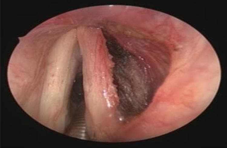 This endoscopic clinical image provides a postoperative view of the larynx following a transoral CO2 laser excision of a deep vocal cord lesion, specifically identified as an adult rhabdomyoma. The view focuses on the glottis, where the left vocal cord appears intact with smooth, pale pink mucosa. In contrast, the right vocal cord shows significant tissue disruption where the microflap technique was utilized. A prominent surgical defect or 'minus' is visible within the right thyroarytenoid muscle area. This surgical cavity exhibits irregular margins and a dark, hemorrhagic base typical of immediate postoperative healing. The surrounding laryngeal mucosa shows reactive erythema and mild edema. This visual demonstrates the immediate anatomical result of a conservative endolaryngeal enucleation of a benign laryngeal tumor, emphasizing the preservation of the superficial mucosal layers while revealing the underlying muscular excision site intended for healing by secondary intention.