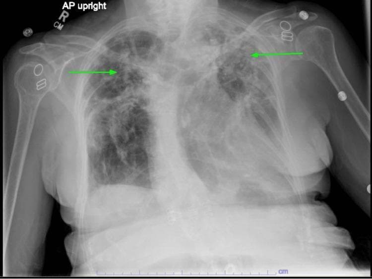 This diagnostic chest x-ray (AP upright projection) demonstrates bilateral upper lung predominant pathology, highlighted by green arrows. The imaging shows extensive areas of increased opacity and reticular markings consistent with chronic fibrotic changes, particularly pronounced in the left apical and upper lobe regions. These findings are characteristic of stage IV sarcoidosis with pulmonary fibrosis and associated architectural distortion, including apical scarring and traction bronchiectasis. The lower lung fields remain relatively lucent compared to the apices. Visible anatomical structures include the bony thorax, mediastinal silhouette, and bilateral humeri. Metallic densities are noted overlying the shoulder regions, likely representing external ECG leads or medical hardware. The radiograph serves as a clinical example of parenchymal lung disease progression and the typical upper-lobe distribution of sarcoidosis-related fibrosis.