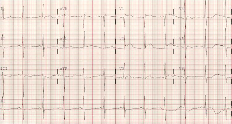 A 12-lead electrocardiogram (ECG) tracing recorded on a standard grid. The rhythm is a regular sinus rhythm, evidenced by uniform P waves preceding every narrow QRS complex. The tracing primarily demonstrates voltage criteria for left ventricular hypertrophy (LVH). Key findings include a prominent R-wave amplitude in lead aVL, which exceeds 12 mm, fulfilling the Modified Cornell Criteria. In the precordial leads, V1 displays a deep S-wave deflection, while leads V5 and V6 show relatively high-amplitude R-waves; however, the sum of S in V1 and R in V5/V6 does not meet the 35 mm threshold for the Sokolow-Lyon criteria. The ST segments are generally isoelectric, and T-waves are upright in the lateral leads without evidence of acute ischemic changes or classic 'strain' patterns. This diagnostic image serves as an educational example of how different LVH voltage criteria (Modified Cornell vs. Sokolow-Lyon) can yield discordant results in the same patient.