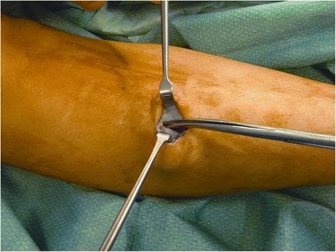 This clinical photograph displays an intraoperative view of a fasciotomy procedure on the leg, specifically targeting the cranial division of the anterior and lateral compartment fascia. The surgical field is prepared with blue-green sterile drapes, revealing a tan-colored limb with a small, vertical incision approximately 2.5 cm in length. Two metal retractors are positioned to hold back the skin and subcutaneous tissue, exposing the underlying deep fascia. A surgical instrument, likely long Metzenbaum-style scissors, is being used to perform a subcutaneous division of the fascia. The whitish, fibrous texture of the deep fascia is visible within the depth of the incision. This visual demonstrates a minimally invasive technique for compartment decompression, emphasizing the anatomical relationship between the skin, subcutaneous layers, and the muscular compartments of the lower leg.