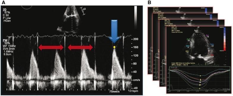 This medical figure illustrates the 'index beat method' for echocardiographic acquisition in patients with atrial fibrillation. Panel A shows a pulse-wave (PW) spectral Doppler tracing of left ventricular outflow tract (LVOT) velocities. Red horizontal arrows highlight the selection of an 'index beat' where the preceding and pre-preceding RR-intervals are similar, ensuring hemodynamic stability for measurement. A blue arrow and yellow dot mark the peak systolic velocity measurement point (approximately 160 cm/s). Panel B demonstrates the application of this method to myocardial strain imaging using speckle tracking echocardiography. It features a layered representation of multiple cardiac cycles, where individual index beats are analyzed and averaged. Each layer includes an apical four-chamber view with regional strain values (e.g., basal, mid, apical segments) and a corresponding longitudinal strain-time graph. The graphs show multicomponent curves representing regional deformation, with a dashed white line indicating the average global longitudinal strain. This methodology aims to improve the reproducibility of systolic and diastolic indices in the presence of irregular heart rhythms.