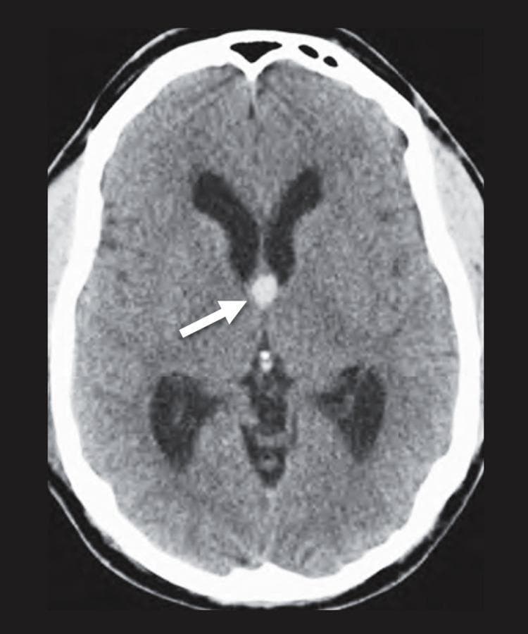 An axial non-contrast cranial CT scan showing a classic presentation of a colloid cyst. A well-circumscribed, homogenously hyperdense, round lesion is centrally located at the level of the foramen of Monro (indicated by a white arrow). The lesion is positioned at the anterosuperior aspect of the third ventricle, causing early-stage obstructive hydrocephalus, as evidenced by the prominent enlargement of both lateral ventricles. The brain parenchyma appears otherwise normal, without significant edema or midline shift beyond the ventricular dilatation. This diagnostic image demonstrates the typical radiological appearance of a third ventricle space-occupying lesion that can lead to acute intracranial pressure elevation due to cerebrospinal fluid (CSF) flow obstruction. The image serves as an educational tool for identifying midline intracranial masses and their associated secondary ventricular effects.