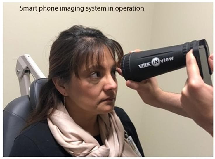 A clinical photograph illustrating the use of a Volk iNview retinal imager, a portable smartphone-based fundus camera, in a clinical setting. The image shows an operator holding a black, cylindrical optical tube attached to a smartphone. To ensure stability and focus, the operator has positioned the large distal end of the lens tube against the patient's forehead, near the superior orbital rim. This stabilization technique allows for fixed-distance (160 mm) imaging of the retina, similar to the optical principles of binocular indirect ophthalmoscopy (BIO). The patient is seated in an examination chair, and the device is aligned with her left eye for fundus photography. This equipment represents a portable solution for ophthalmic screening in primary care, emergency departments, or global health settings where stationary slit-lamp-mounted fundus cameras are unavailable. The image demonstrates the interface between medical technology and patient positioning for non-mydriatic or portable retinal imaging.