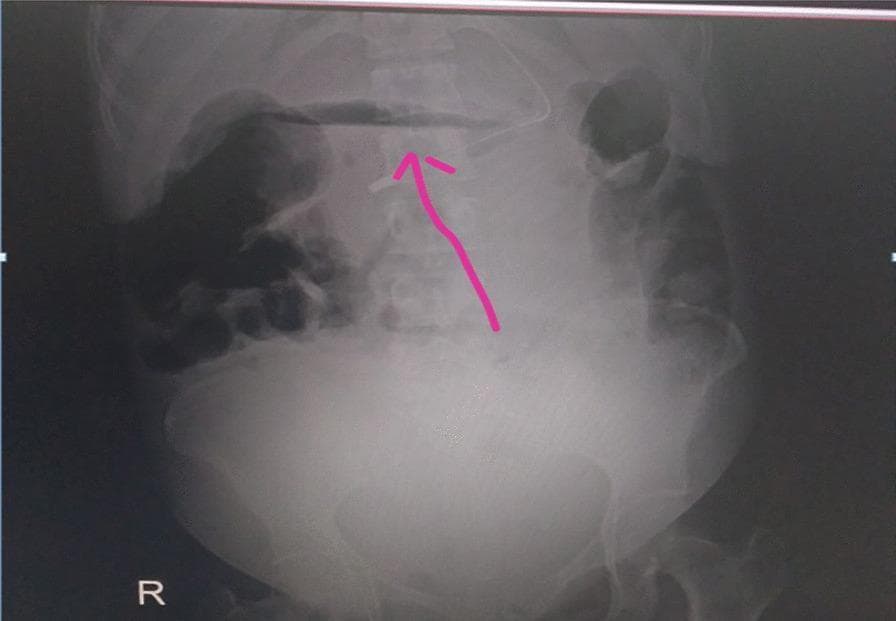 This diagnostic image is an upright abdominal X-ray (radiography) focusing on the upper abdominal region. The primary clinical finding is a prominent crescent-shaped area of increased radiolucency (darkness) located directly beneath the diaphragm, as indicated by the pink arrow. This radiographic sign, known as pneumoperitoneum, represents free intraperitoneal air, which in this clinical context is suggestive of a perforated hollow viscus, such as a peptic ulcer or duodenal perforation. The vertebral column is visible centrally, and the bowel gas pattern shows mottled soft tissue and gas densities. A large, well-defined convex opacity in the lower abdomen suggests the presence of a gravid uterus or a significant intra-abdominal mass, consistent with the patient's late-term pregnancy mentioned in the clinical context. The image serves as a critical educational example of 'free air under the diaphragm,' a surgical emergency requiring immediate intervention such as laparotomy.
