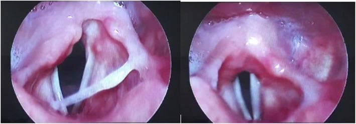 This diagnostic image consists of two side-by-side circular frames obtained via flexible fibro-optic laryngoscopy, showing the internal anatomy of the larynx. The image demonstrates a clinical case of right vocal cord paralysis. The vocal cords appear as distinct, whitish, band-like structures contrasting against the surrounding reddish laryngeal mucosa. In the left frame, the larynx is shown during inspiration or abduction, where a significant asymmetry is visible: the left vocal cord is abducted (opened) normally, while the right vocal cord remains fixed or sluggish near the midline (paramedian position). The right frame shows the glottis during a different phase of movement or phonation, where the cords fail to meet symmetrically. Key anatomical landmarks visible include the arytenoid cartilages at the posterior aspect and the epiglottic region superiorly. The mucosa appears generally healthy with no visible masses, lesions, or ulcerations. This visual material is used in otolaryngology to teach the endoscopic diagnosis of cranial nerve X (vagus nerve) or recurrent laryngeal nerve dysfunction, potentially secondary to viral infections such as COVID-19.