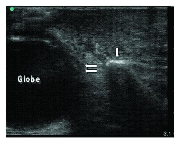 This diagnostic ultrasound image, captured in a transverse view using a high-frequency linear probe, demonstrates the bedside evaluation of periorbital and malar soft tissue. The left side of the image reveals the hypoechoic, circular structure of the ocular globe, with its posterior edge demarcated by double horizontal arrows. To the right, a bright, hyperechoic linear interface indicated by a single vertical arrow represents the cortical surface of the maxilla. The overlying subcutaneous soft tissue exhibits the classic sonographic appearance of cellulitis, characterized by 'cobblestoning.' This pattern is formed by hypoechoic streaks representing inflammatory fluid and edema that disrupt the normally organized, echogenic subcutaneous fat and connective tissue planes. The image serves as an educational example for differentiating bone, fluid-filled structures (globe), and inflammatory soft tissue changes (cellulitis) in the maxillofacial region, highlighting the utility of ultrasound in evaluating preseptal infections.
