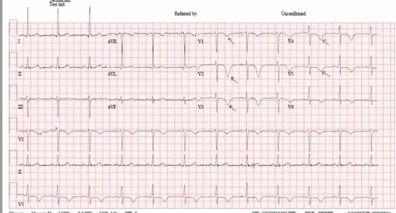 This diagnostic image is a 12-lead electrocardiogram (ECG) demonstrating classic features of Wellens syndrome (Type B pattern). The primary finding is deep, symmetric T-wave inversion across the precordial leads V1 through V6. Black arrows in leads V1 to V5 highlight the sharply pointed, inverted T-waves. Similar T-wave inversion is also present in lead aVL, suggesting high lateral involvement. The ST segments remain relatively isoelectric without significant elevation or depression, and there is a preserved R-wave progression. These findings in the context of a patient who is currently pain-free or experiencing subsiding chest pain are highly indicative of critical proximal left anterior descending (LAD) coronary artery stenosis. This ECG serves as an important educational example for distinguishing pre-infarction states from non-specific ST-T wave changes, emphasizing the clinical significance of symmetric T-wave morphology in the precordial leads for identifying high-risk cardiovascular patients.