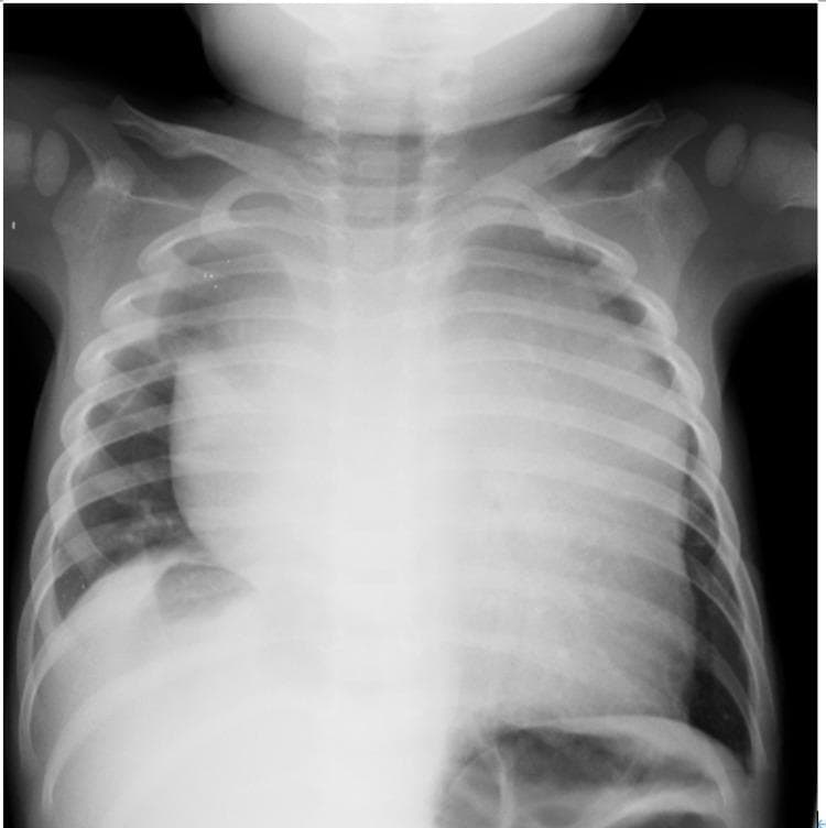 Anterior-posterior (AP) pediatric chest X-ray demonstrating a significant, abnormal expansion of the mediastinal shadow. The central opacity is markedly widened, obscuring the normal cardiac borders and silhouettes of the great vessels. This large, homogenous mass occupies the anterior and superior mediastinal compartments, causing lateral displacement of the lung fields. While the lung parenchyma appears relatively clear and aerated, there is evidence of mass effect on adjacent structures. The skeletal framework, including ribs and clavicles, appears intact. In a pediatric context, this visual presentation is highly suggestive of a large mediastinal mass, such as a lymphoma, thymoma, or germ cell tumor, which may present with acute respiratory distress due to tracheal compression or superior vena cava syndrome. The image illustrates the classic radiographic sign of mediastinal widening essential for medical students and clinicians in identifying potential intrathoracic emergencies.