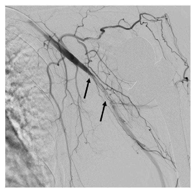 This diagnostic image is a digital subtraction angiogram (DSA) of the left upper extremity, demonstrating vascular pathology in the axillary and brachial arteries. Two black arrows highlight key findings. The superior arrow points to an area of total occlusion in the distal axillary artery, characterized by an abrupt termination of contrast column filling. The inferior arrow indicates the proximal brachial artery, where an irregular, linear contrast pattern suggests a dissection, likely occurring in a subintimal plane. Proximally, the subclavian artery appears patent with smooth contrast flow. Distal to the site of dissection, the brachial artery reconstitutes and remains patent, leading to normally opacified radial and ulnar arteries. The image is clinically significant for diagnosing acute or procedural-related vascular injury, such as arterial dissection and occlusion, requiring interventional management like angioplasty or stenting. It serves as an educational example of upper limb arterial anatomy and common angiographic findings in vascular surgery and radiology.